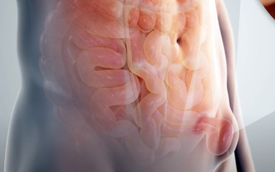 ¿Qué es una hernia inguinal?